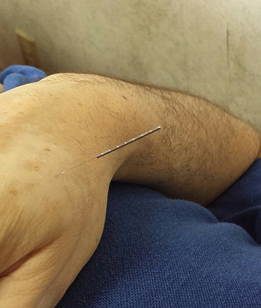 accupuncture